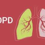 Chronic Obstructive Pulmonary Disease | POPD