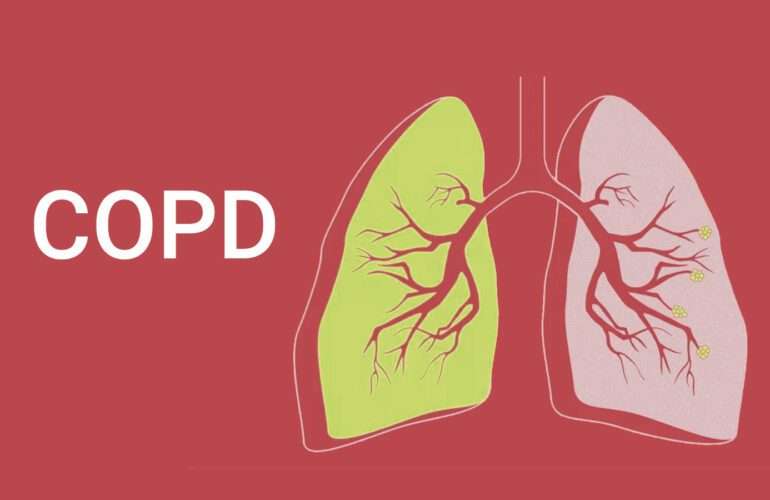 Chronic Obstructive Pulmonary Disease | POPD